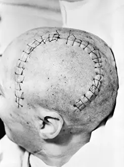Cutting Prints: Sewn Wound On Shaven Skull From Surgery