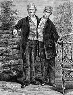 Siamese Twins Attached at Chest