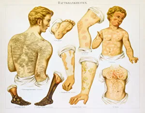 Images Dated 1st July 2015: Skin diseases lithography 1895