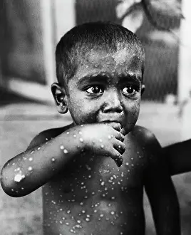 Smallpox Prints: Small Boy Suffering from Smallpox