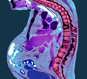 Bizarre Collection: Spine in ankylosing spondylitis, X-ray