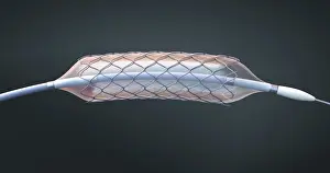 Stent and balloon catheter, illustration