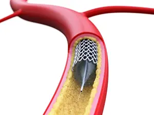Graphic Prints: Stent inside of an artery, illustration
