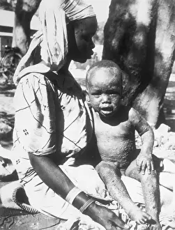 Stricken Baby and Mother