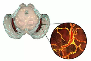 Biological Gallery: Substantia nigra in Parkinsons disease, illustration