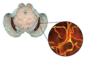 Area Collection: Substantia nigra in Parkinsons disease, illustration