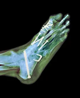 X Ray Prints: Surgical fixation for rheumatoid arthritis of feet, X-ray