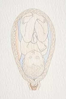 Swollen womb with inverted foetus head pointing to cervix opening