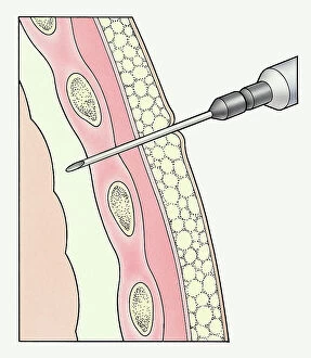 Dorling Kindersley Prints Collection: Syringe entering pleural membranes around human lung to extract sample