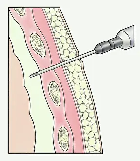Human Lung Prints: Syringe entering pleural membranes around human lung to extract sample