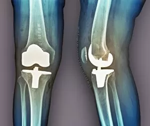Detail Gallery: Total knee replacement, X-rays
