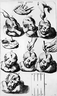 Trepanation