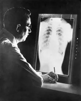 X Ray Prints: Tuberculosis X-Ray