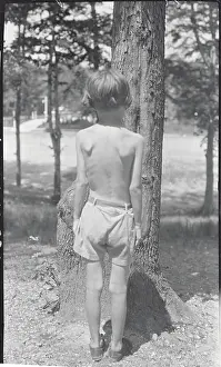 Tuberculosis Prints: Back View of Child with Tuberculosis