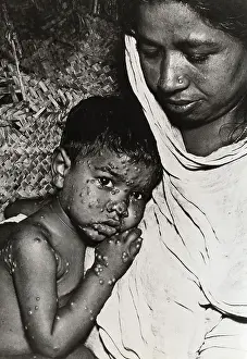 Smallpox Prints: Woman Holding Boy with Smallpox