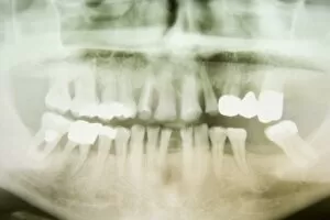 Images Dated 13th March 2010: X-ray image of a human jaw with treated teeth, Germany, Europe